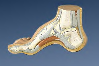 Pes cavus model Pes cavus model