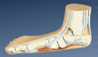 Pes planus model Pes planus model